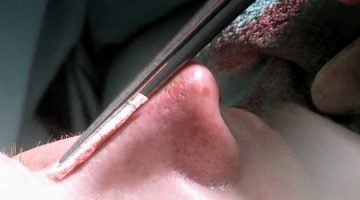 A portion of human tissue is used in a nasal reconstruction surgical procedure