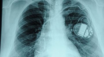 Pacemaker X-Ray