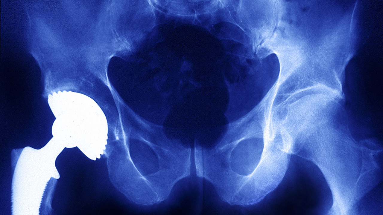 X-ray of a prosthetic hip implant