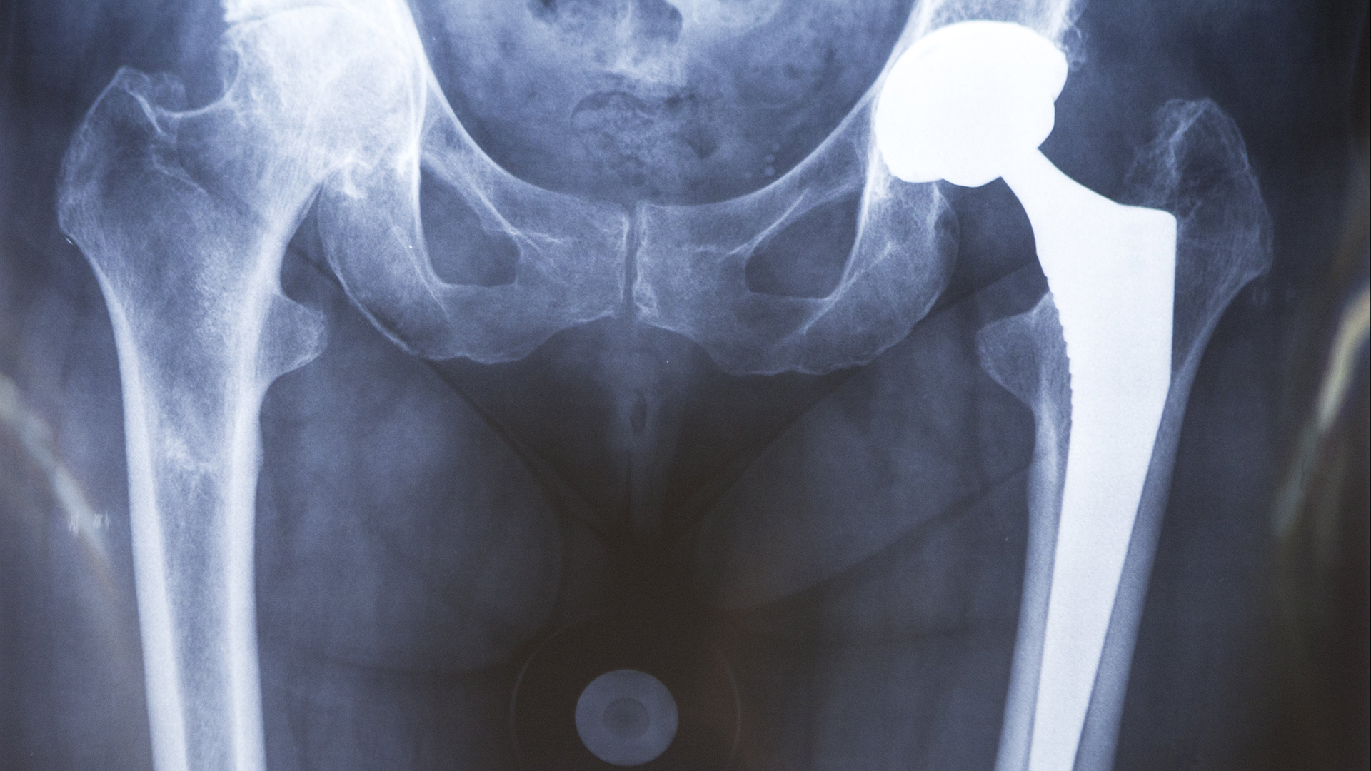 Hidden dangers: patients, doctors not informed of defective implants
